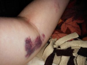 Arm bruised by use of bow.